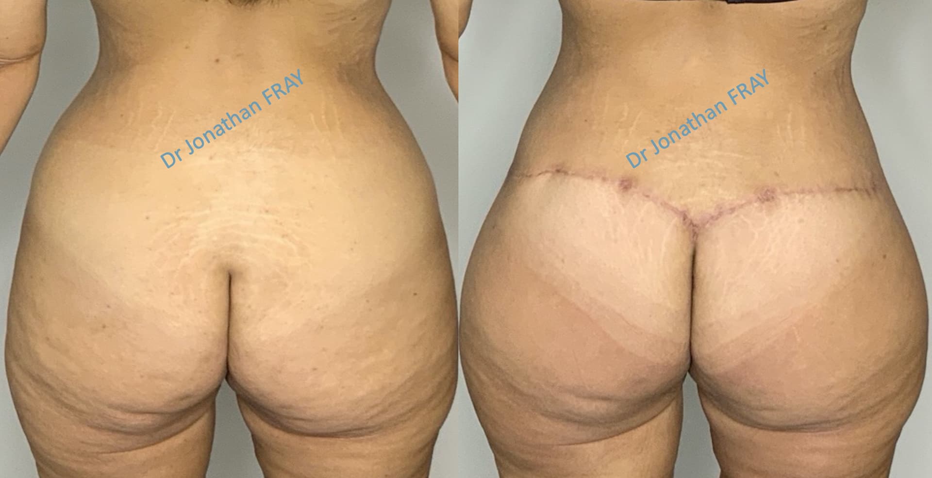 bodylift-4-avant-apres-3