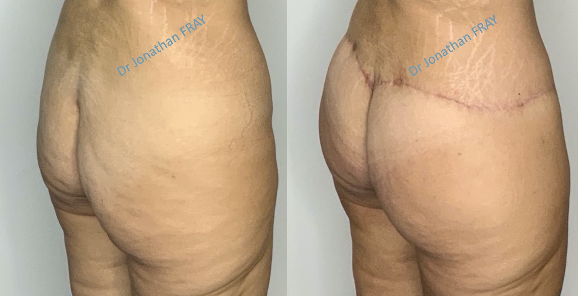 bodylift-4-avant-apres-4