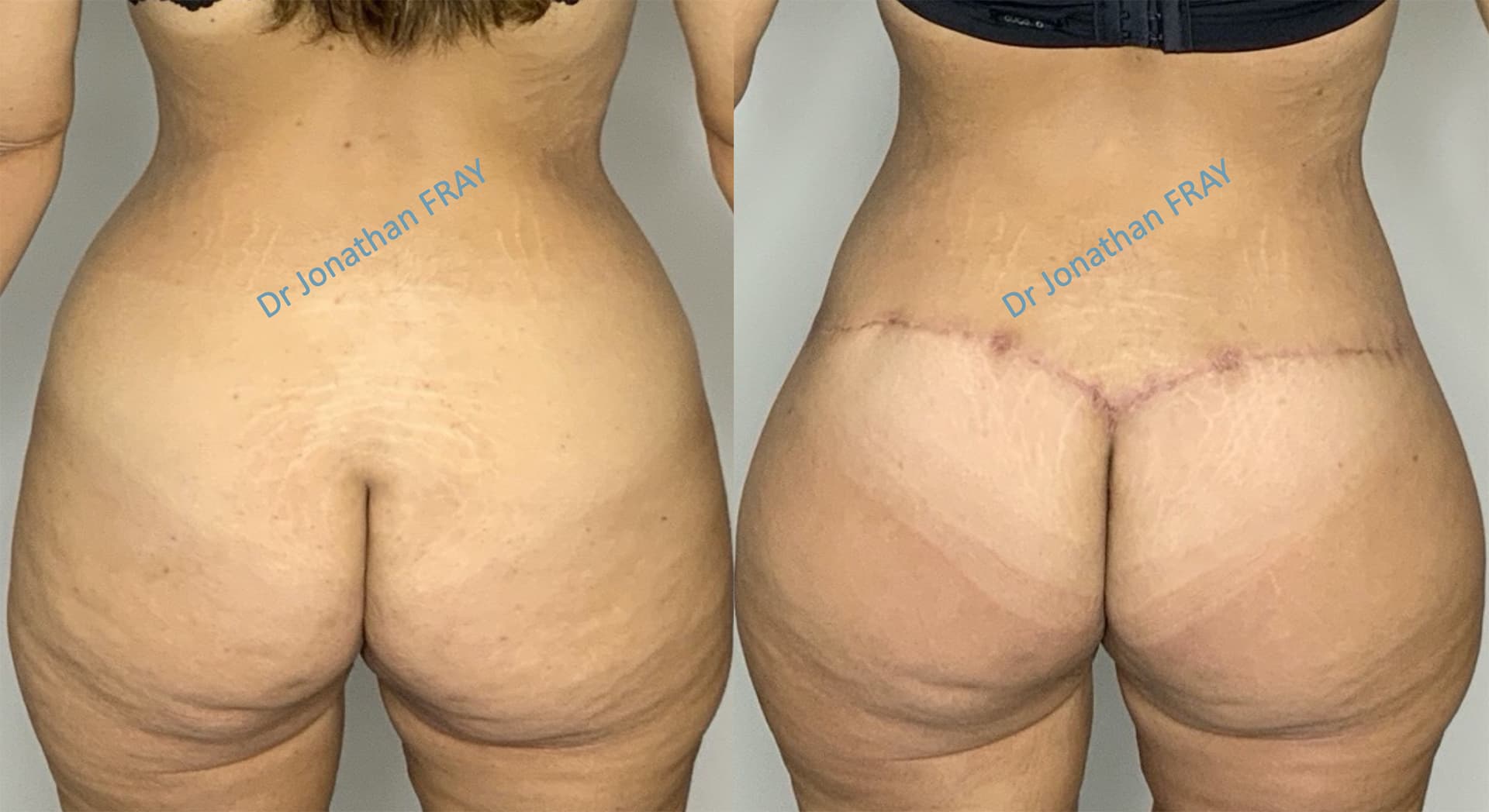 lifting-fesses-1-avant-apres-1