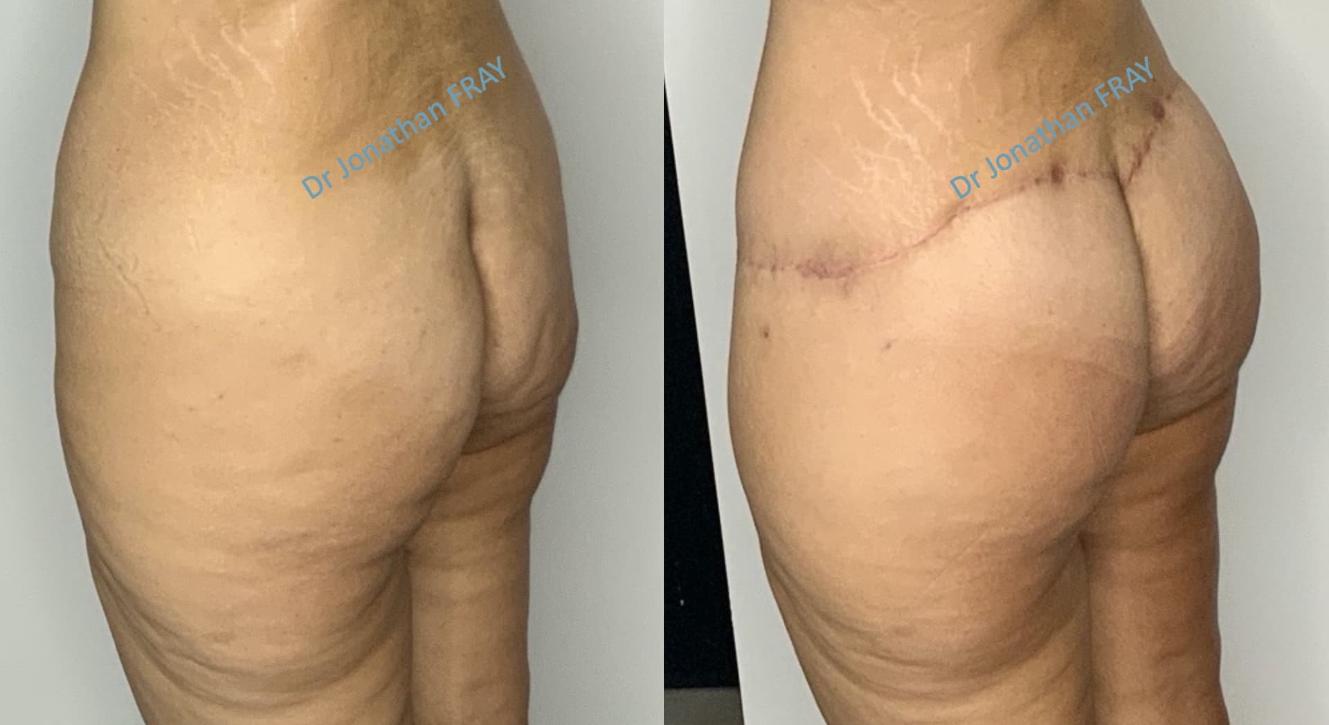 lifting-fesses-1-avant-apres-2