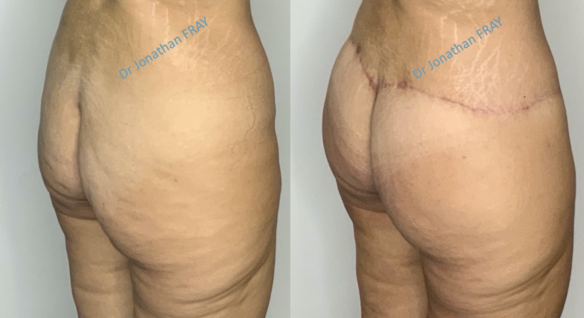 lifting-fesses-1-avant-apres-3