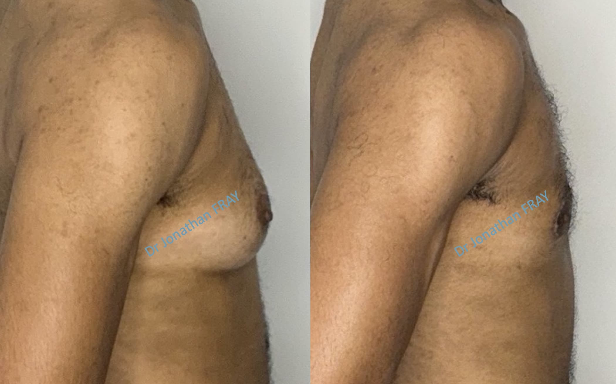 gynecomastie-3-avant-apres-1 Exemple de résultat avant après d'une gynécomastie effectuée par le Dr Fray à La Réunion (vue de profil)