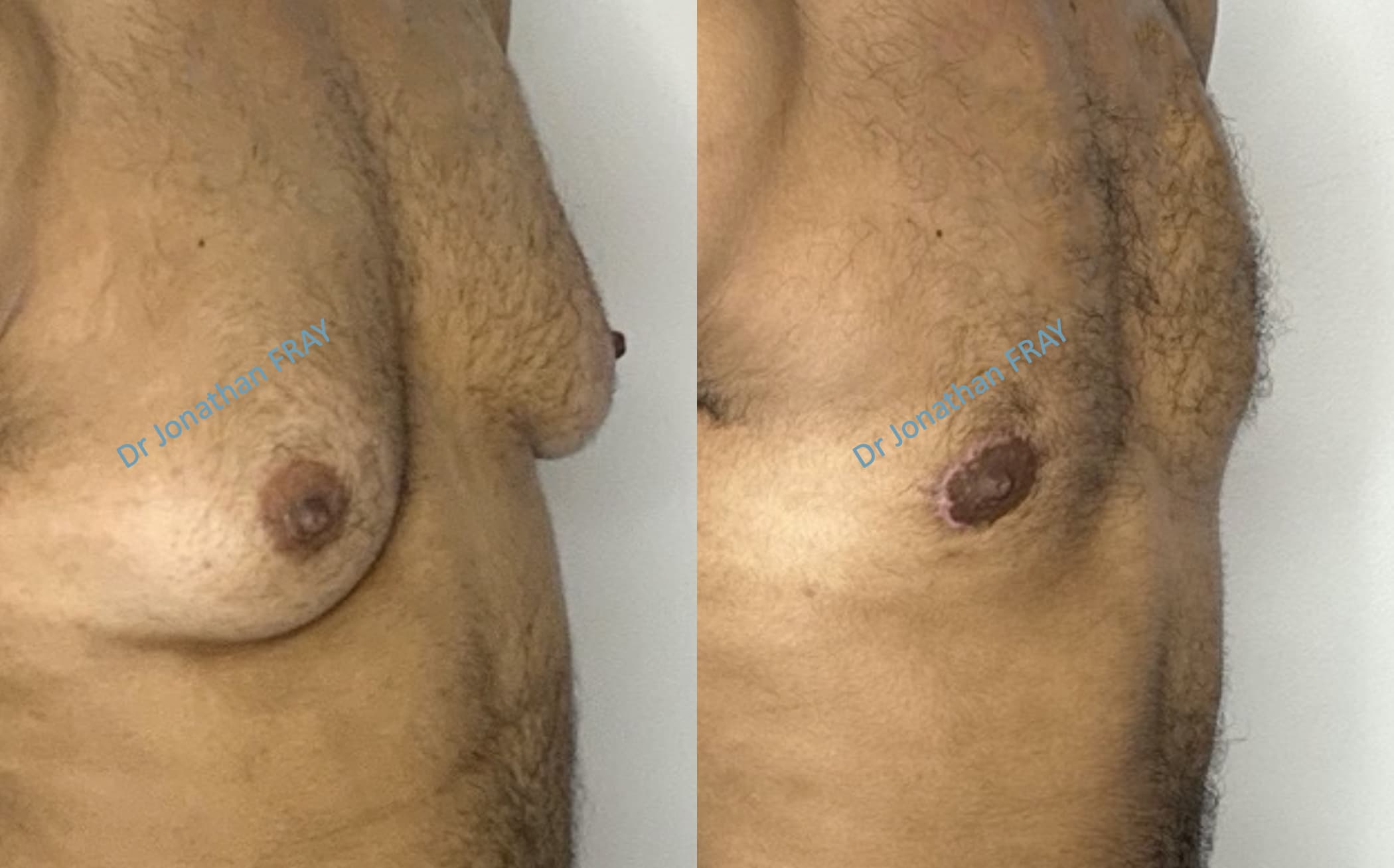 gynecomastie-3-avant-apres-2 Exemple de résultat avant après d'une gynécomastie effectuée par le Dr Fray à La Réunion (vue de 3/4)