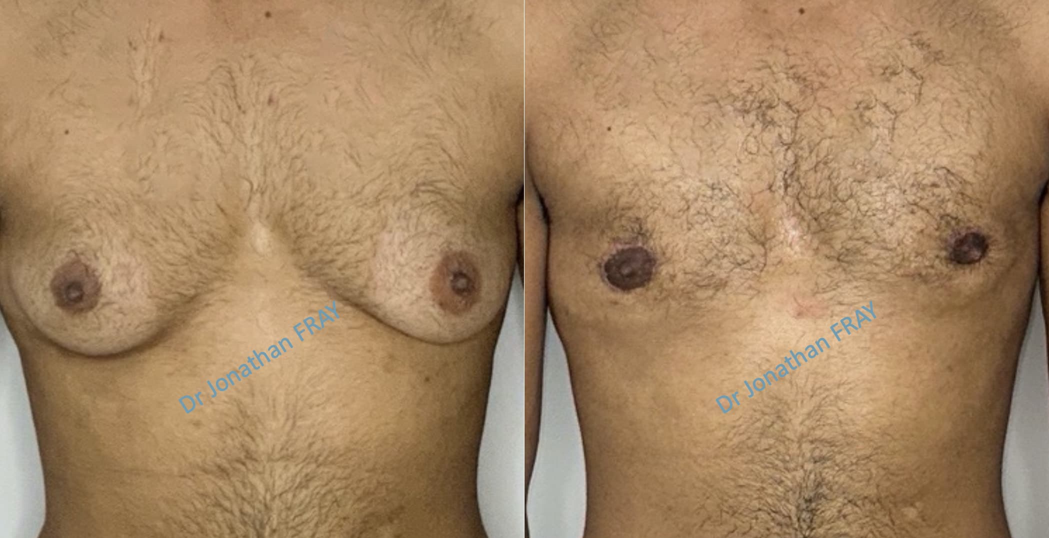 gynecomastie-3-avant-apres-3 Exemple de résultat avant après d'une gynécomastie effectuée par le Dr Fray à La Réunion (vue de face)