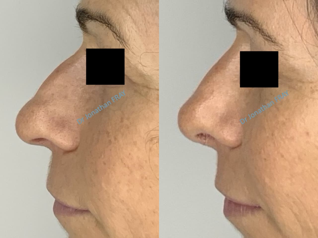 rhinoplastie-6-avant-apres-1