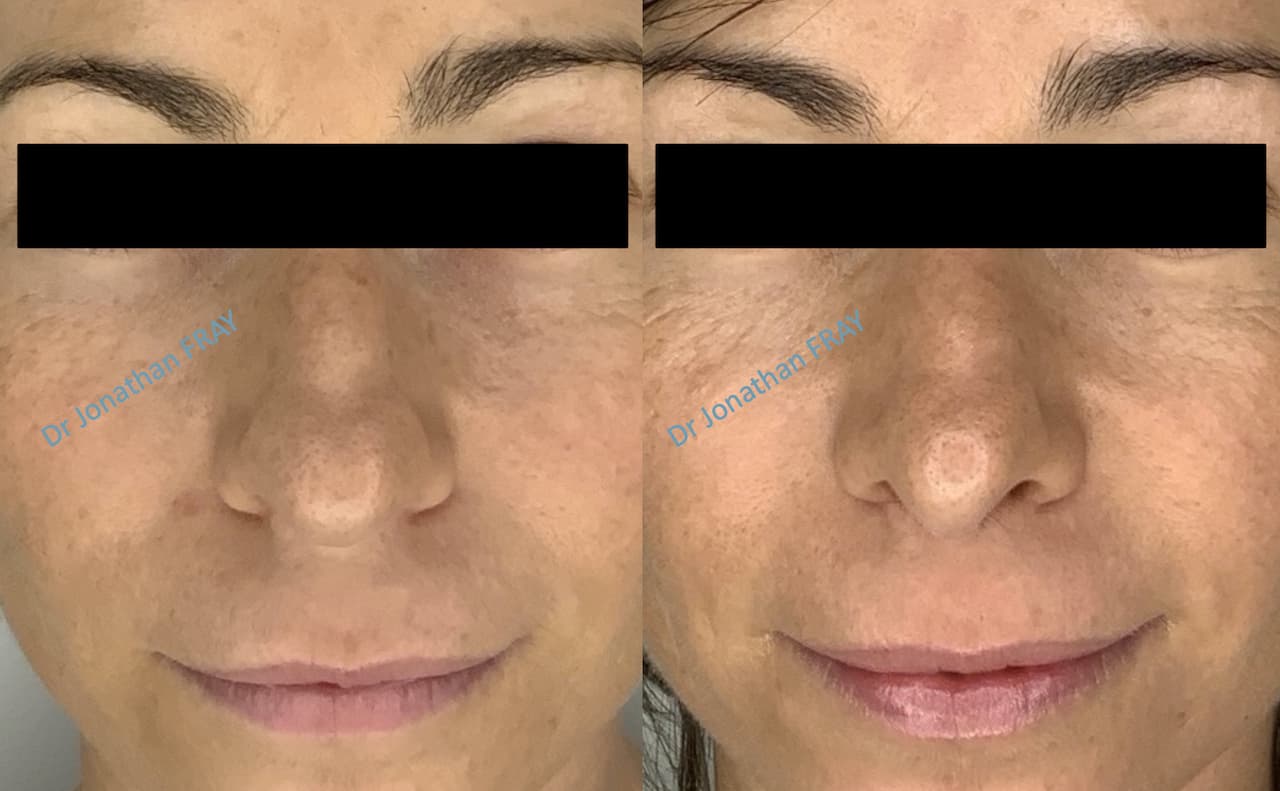 rhinoplastie-6-avant-apres-2
