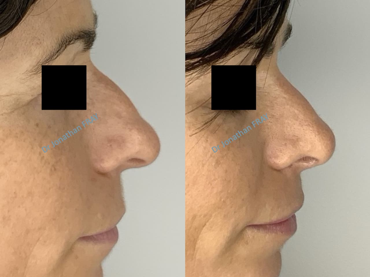 rhinoplastie-6-avant-apres-3