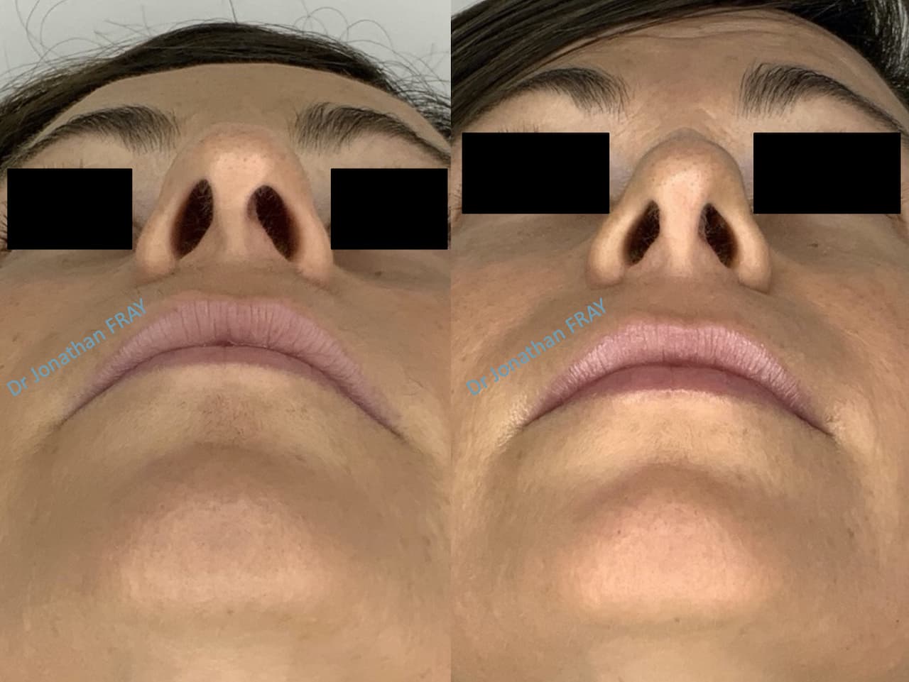 rhinoplastie-6-avant-apres-4