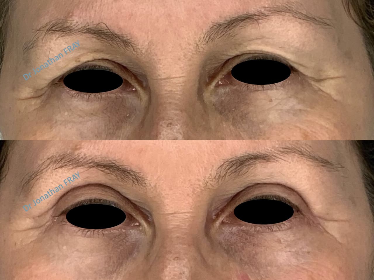 Résultat avant après d'une blépharoplastie supérieure réalisée par le docteur Jonathan Fray à La Réunion (vue 1)