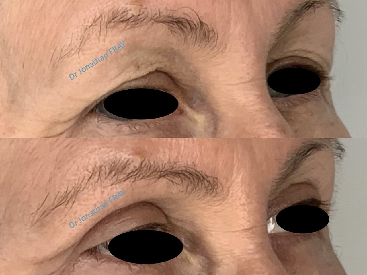 Résultat avant après d'une blépharoplastie supérieure réalisée par le docteur Jonathan Fray à La Réunion (vue 2)