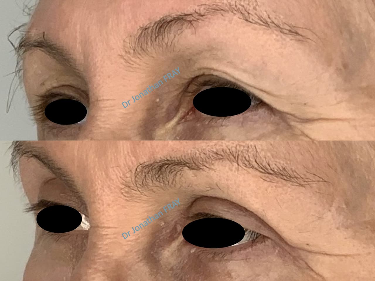 Résultat avant après d'une blépharoplastie supérieure réalisée par le docteur Jonathan Fray à La Réunion (vue 3)