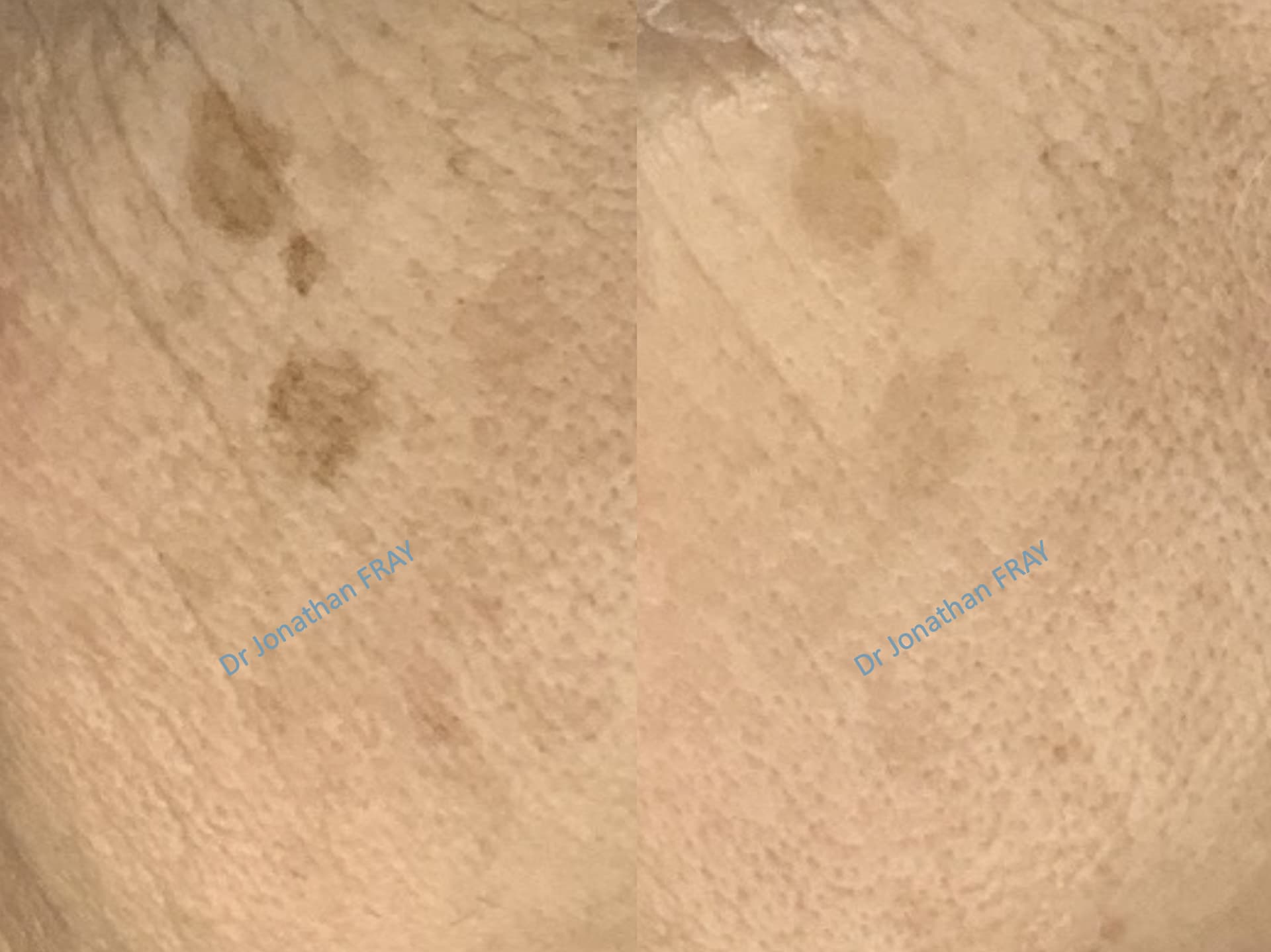 Exemple des effets avant après d'un traitement par laser pigmentaire par le Dr Fray à La Réunion