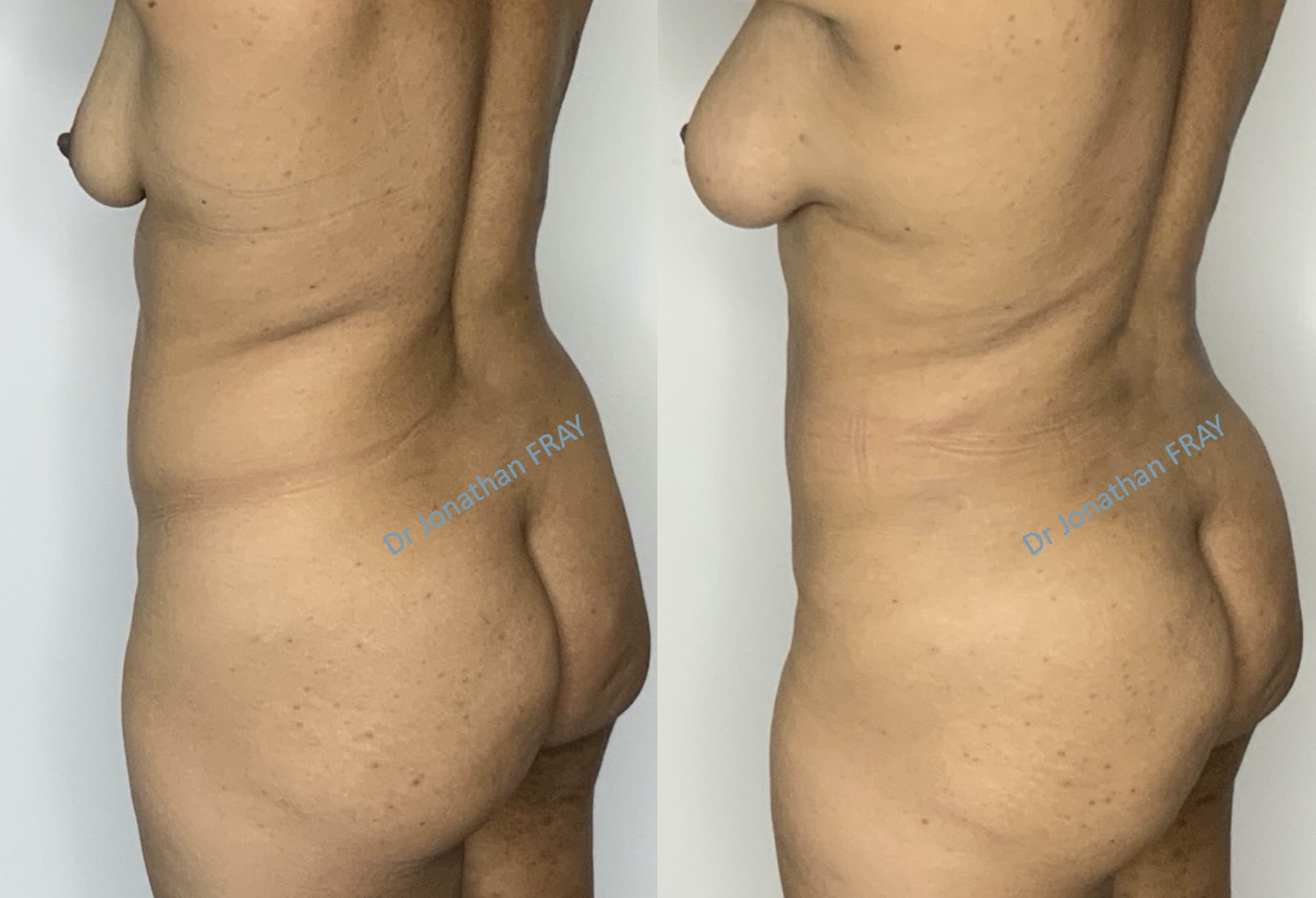 Exemple avant après de résultat d'une lipostructure de la poitrine réalisée par le Dr Fray à La Réunion - vue 1