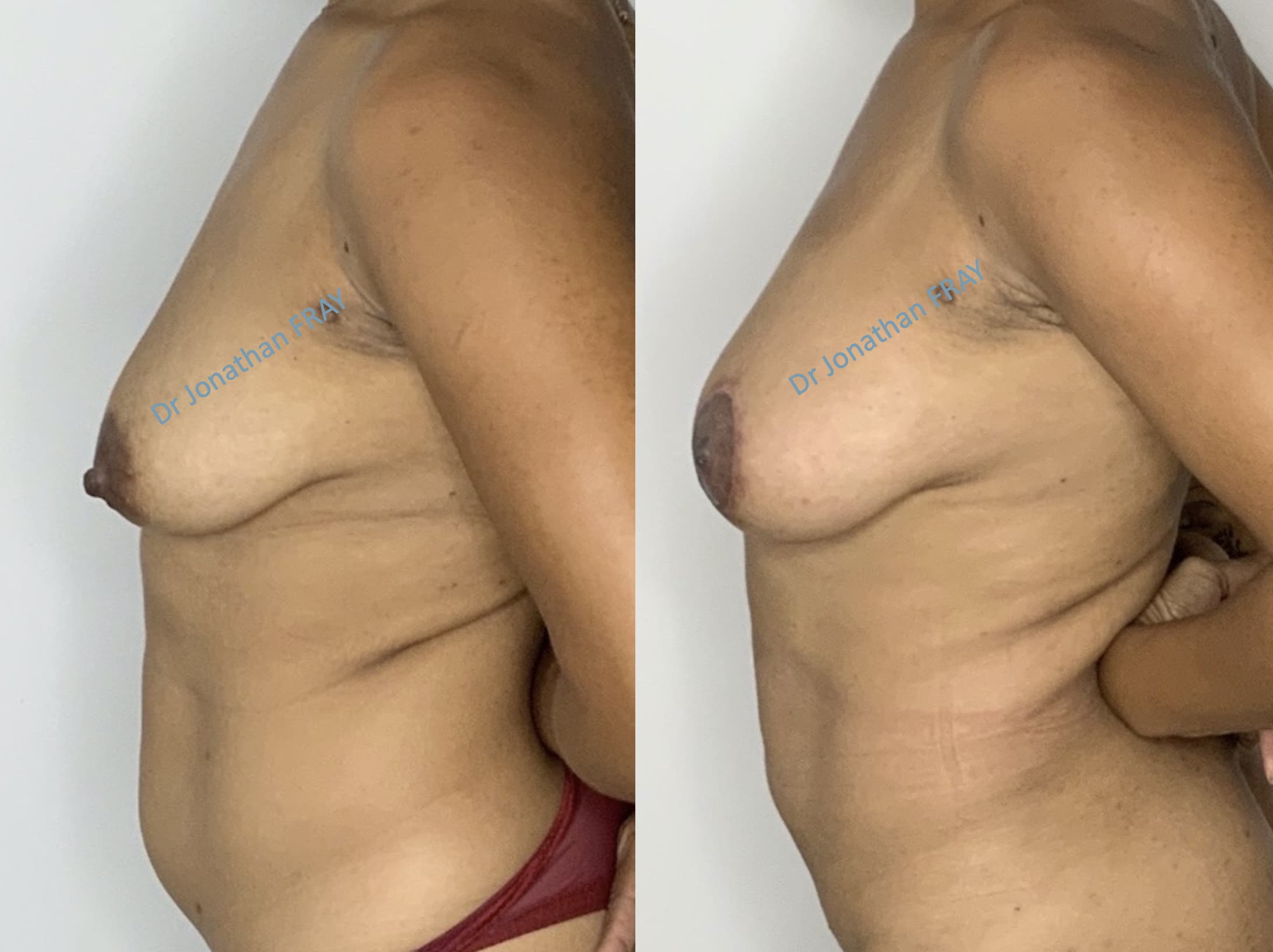 Exemple avant après de résultat d'une lipostructure de la poitrine réalisée par le Dr Fray à La Réunion - vue 2
