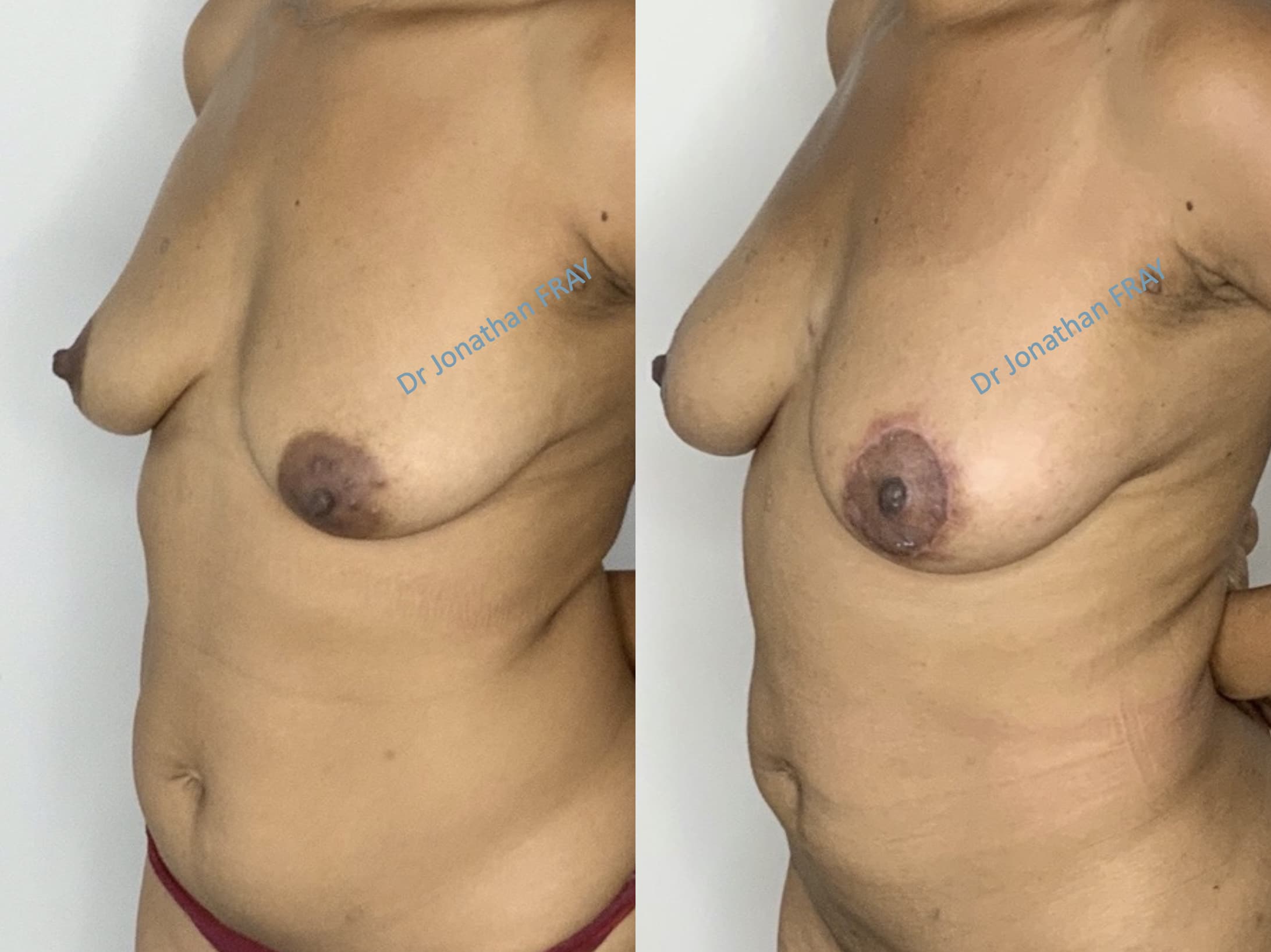 Exemple avant après de résultat d'une lipostructure de la poitrine réalisée par le Dr Fray à La Réunion - vue 3