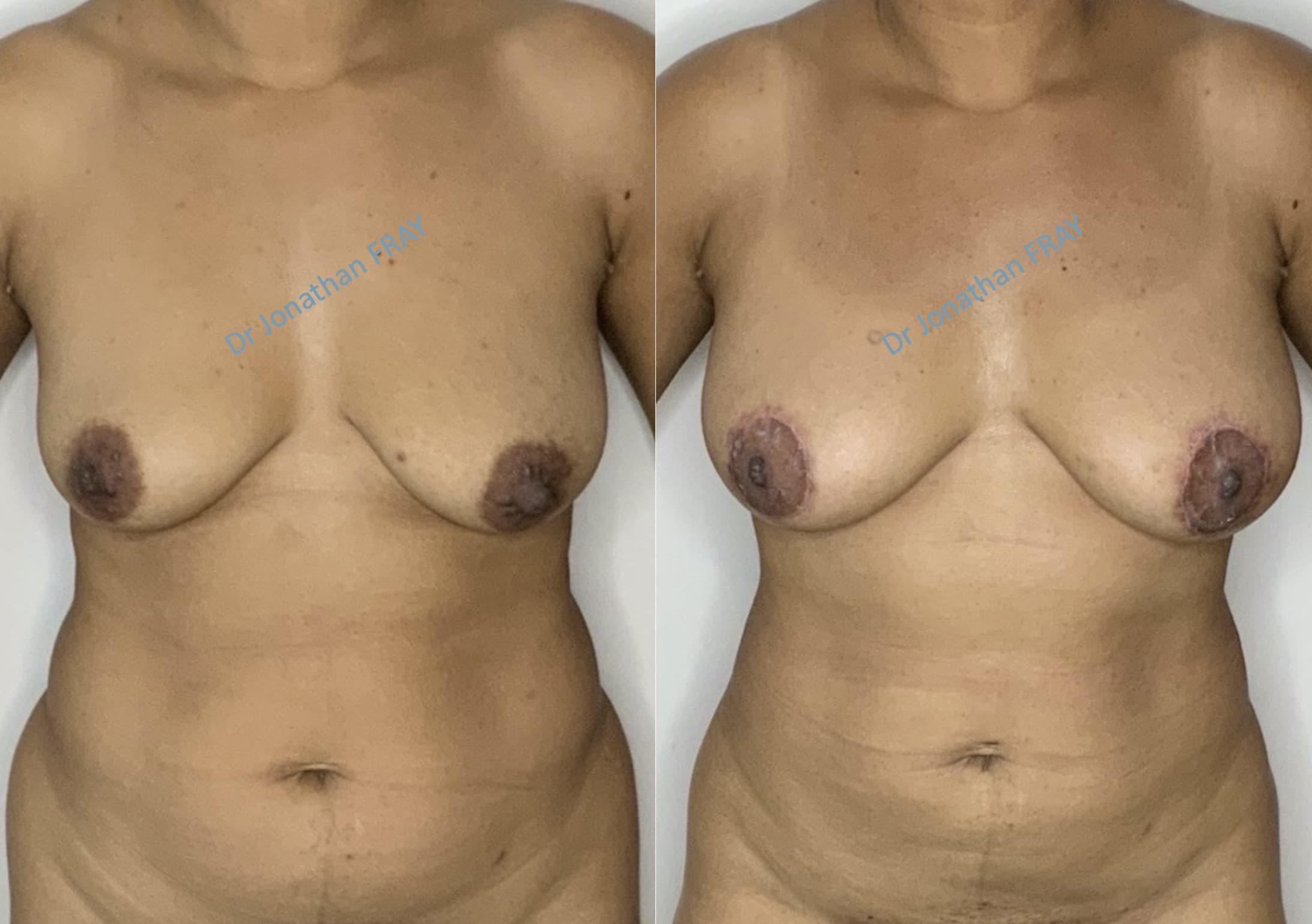 Exemple avant après de résultat d'une lipostructure de la poitrine réalisée par le Dr Fray à La Réunion - vue 4