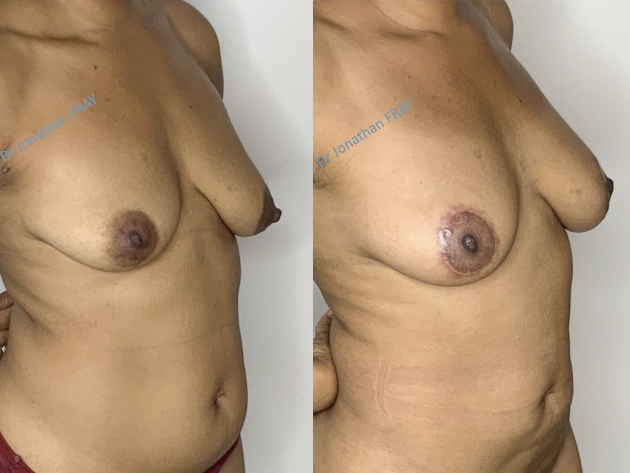 Exemple avant après de résultat d'une lipostructure de la poitrine réalisée par le Dr Fray à La Réunion - vue 5