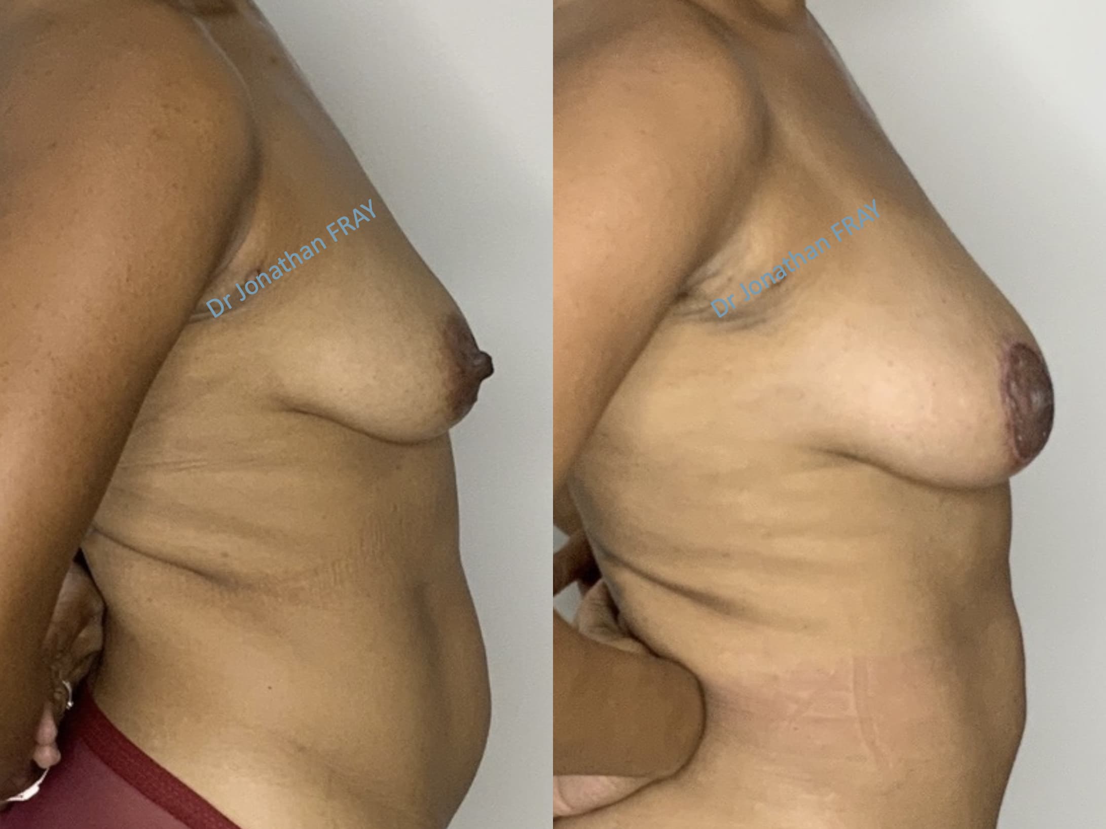 Exemple avant après de résultat d'une lipostructure de la poitrine réalisée par le Dr Fray à La Réunion - vue 6