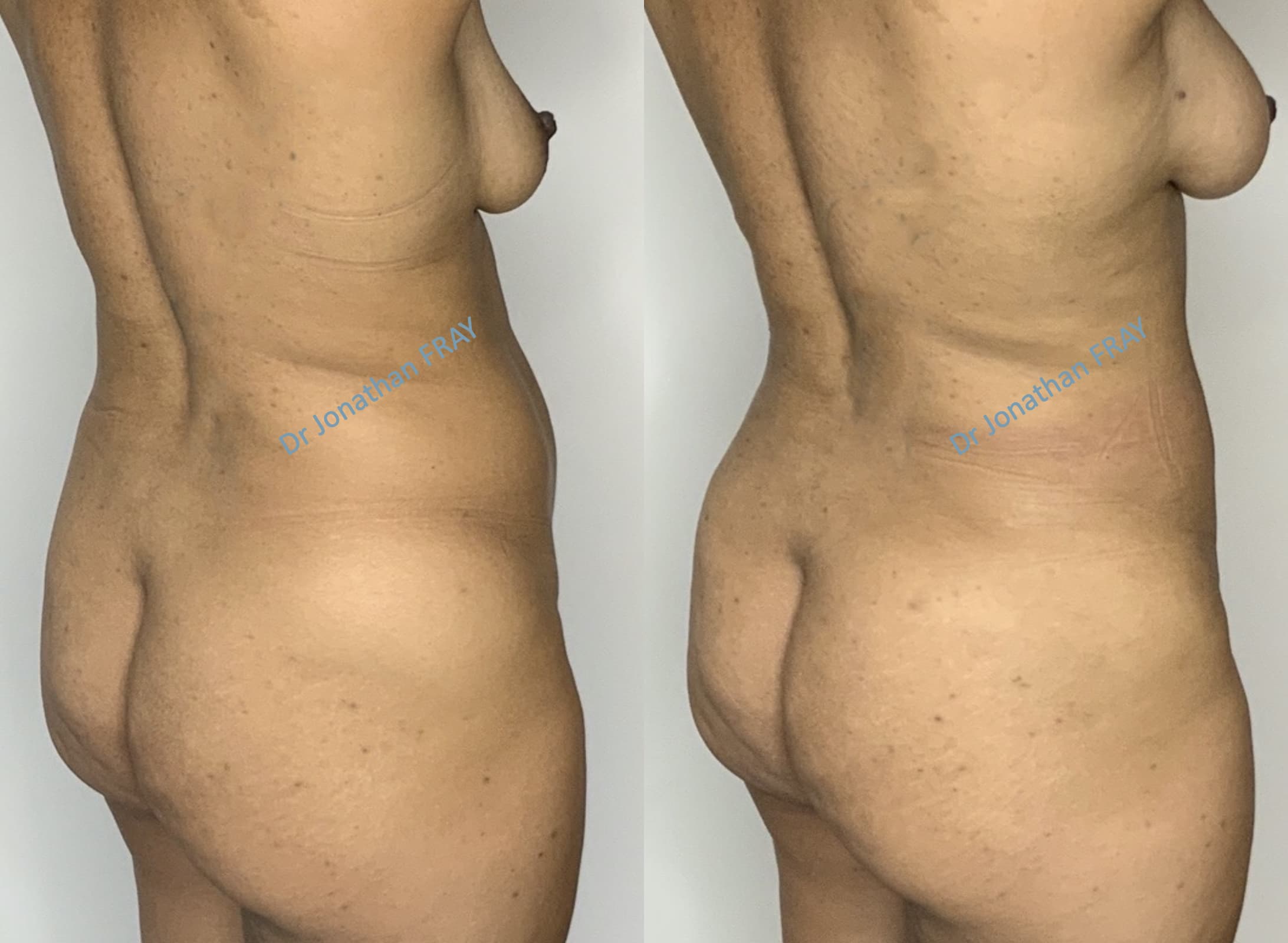 Exemple avant après de résultat d'une lipostructure de la poitrine réalisée par le Dr Fray à La Réunion - vue 7