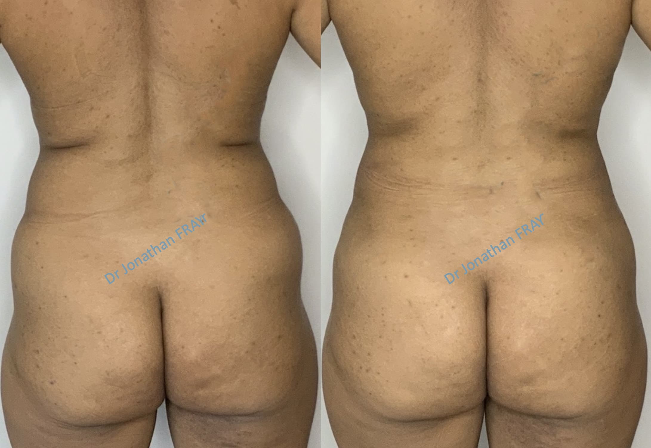 Exemple avant après de résultat d'une lipostructure de la poitrine réalisée par le Dr Fray à La Réunion - vue 8