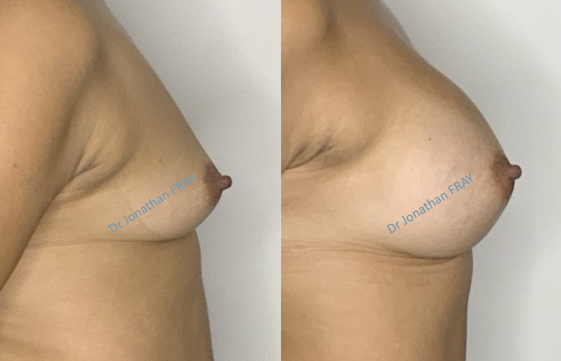 Résultats avant après d'une augmentation mammaire par implants réalisée par le Dr Fray à La Réunion - vue 1