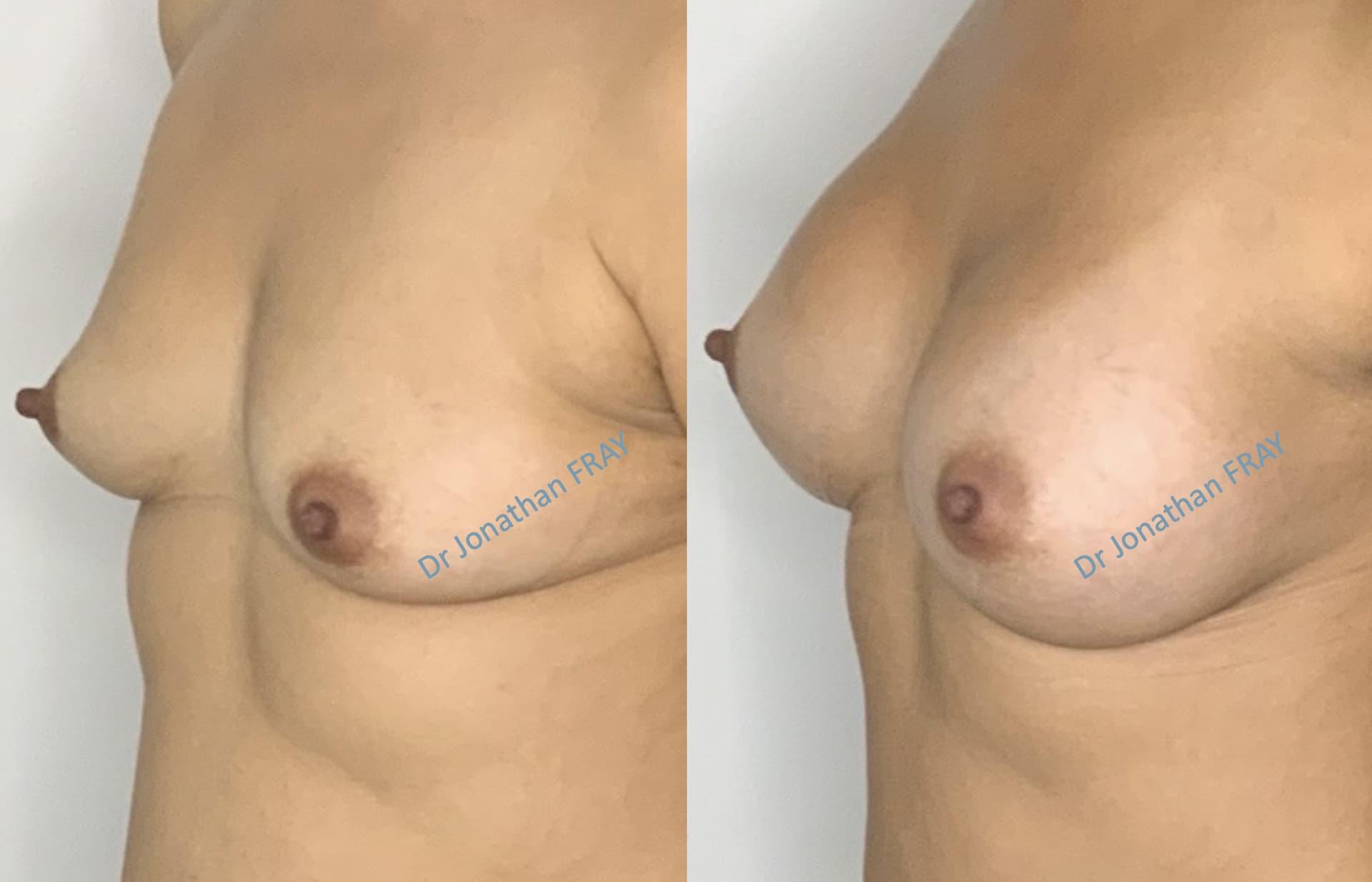Résultats avant après d'une augmentation mammaire par implants réalisée par le Dr Fray à La Réunion - vue 5