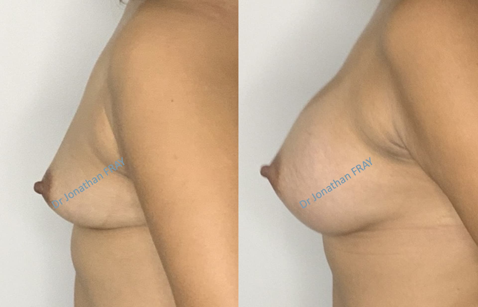 Résultats avant après d'une augmentation mammaire par implants réalisée par le Dr Fray à La Réunion - vue 6