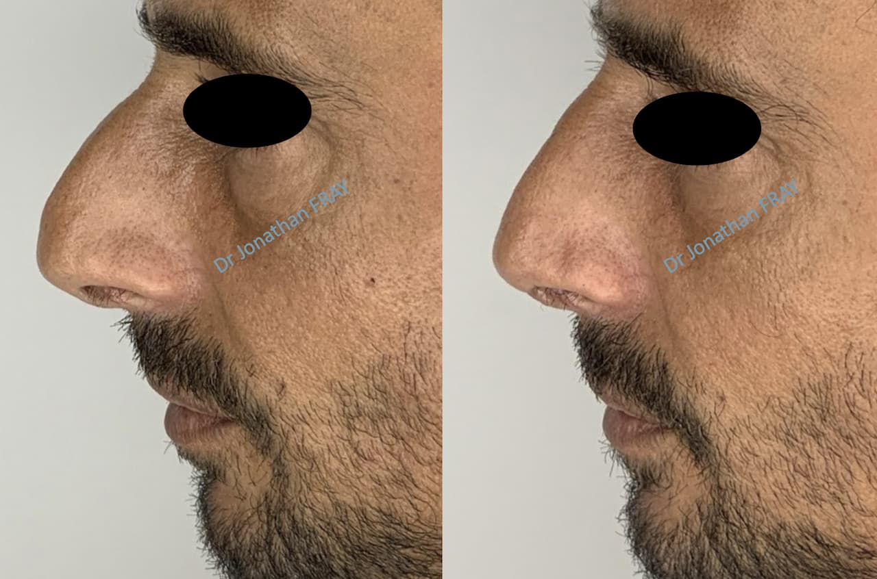 rhinoplastie-7-avant-apres-1