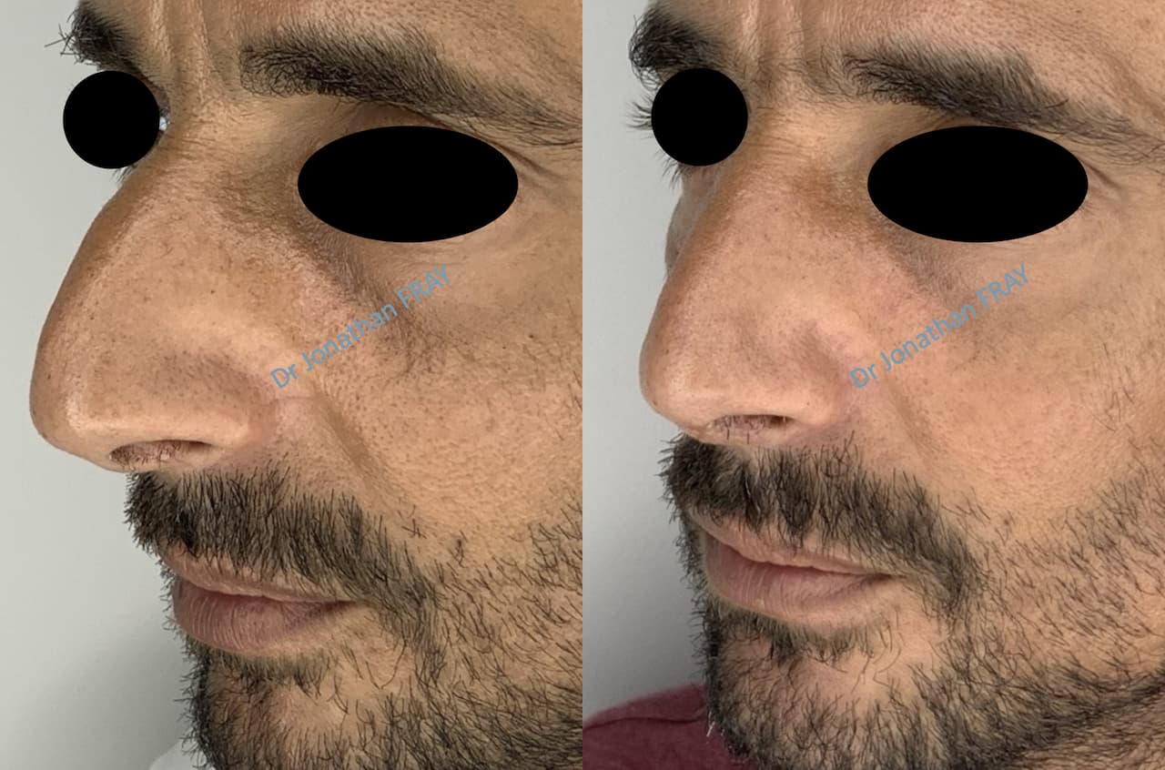rhinoplastie-7-avant-apres-2