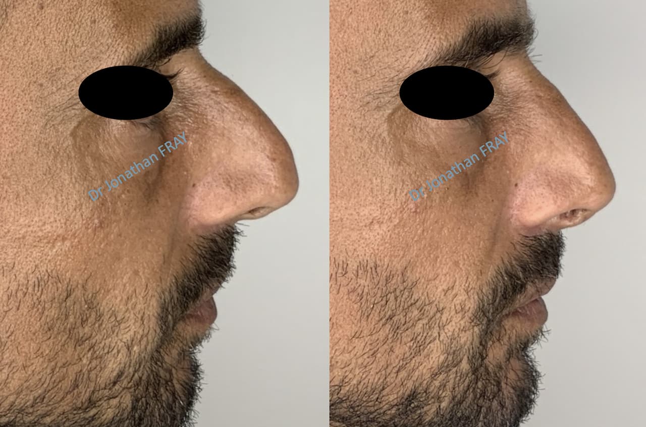 rhinoplastie-7-avant-apres-3