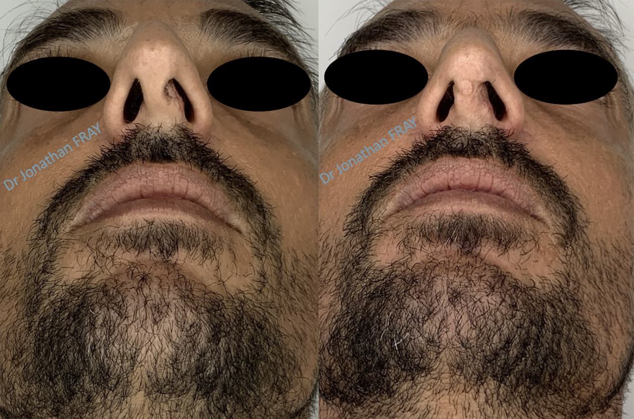 rhinoplastie-7-avant-apres-4