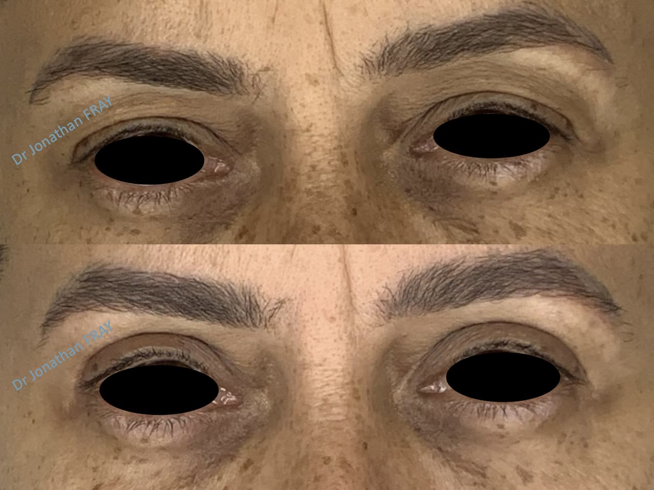 Résultats avant après d'une blépharoplastie supérieure par le Dr Fray à La Réunion - vue 3