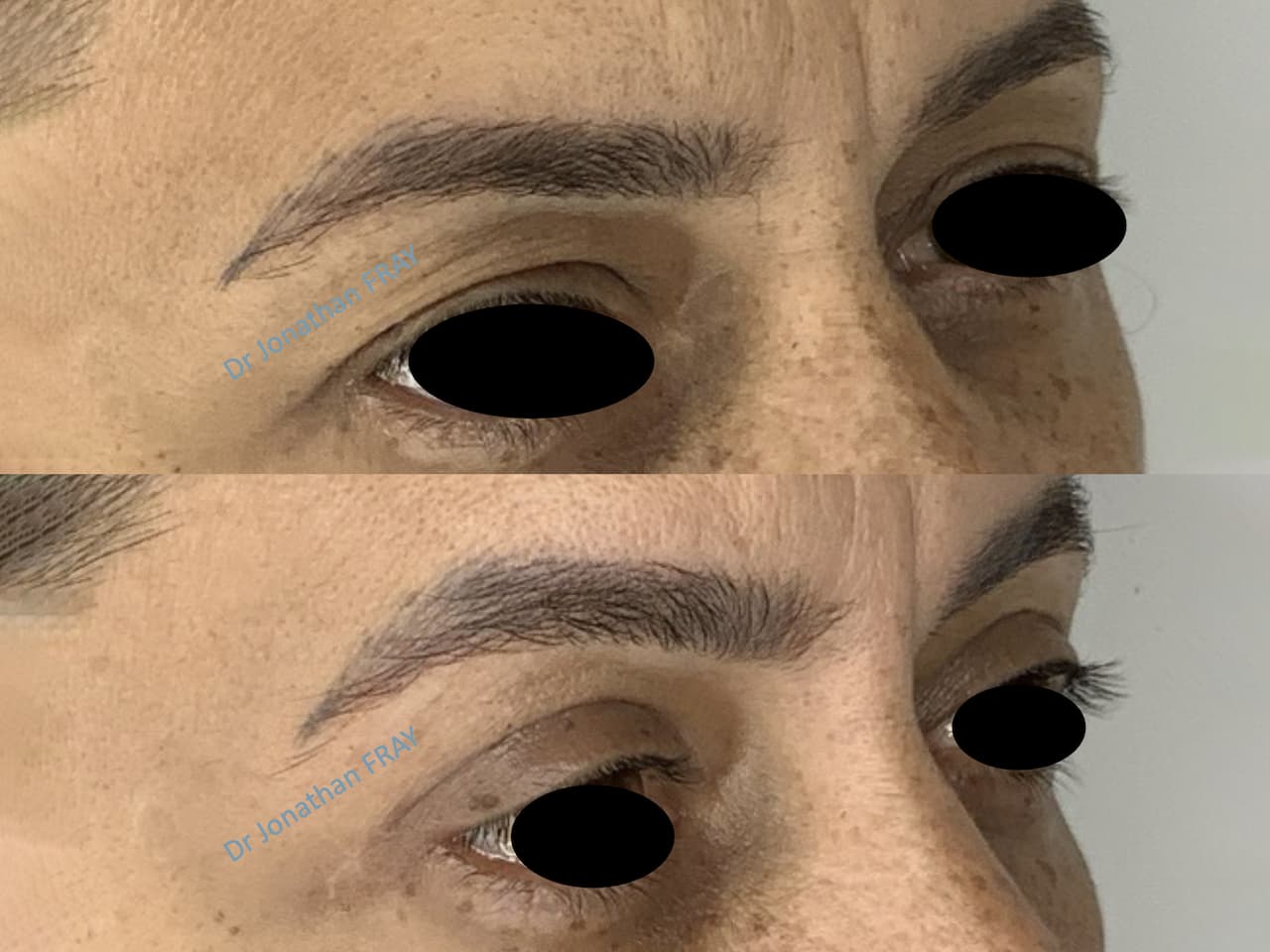 Résultats avant après d'une blépharoplastie supérieure par le Dr Fray à La Réunion - vue 2