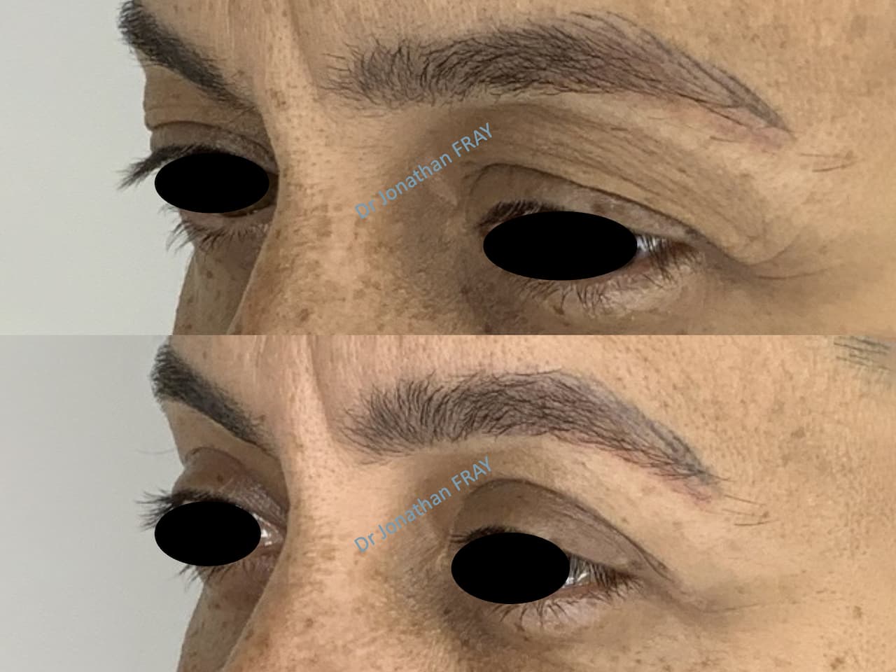 Résultats avant après d'une blépharoplastie supérieure par le Dr Fray à La Réunion - vue 1