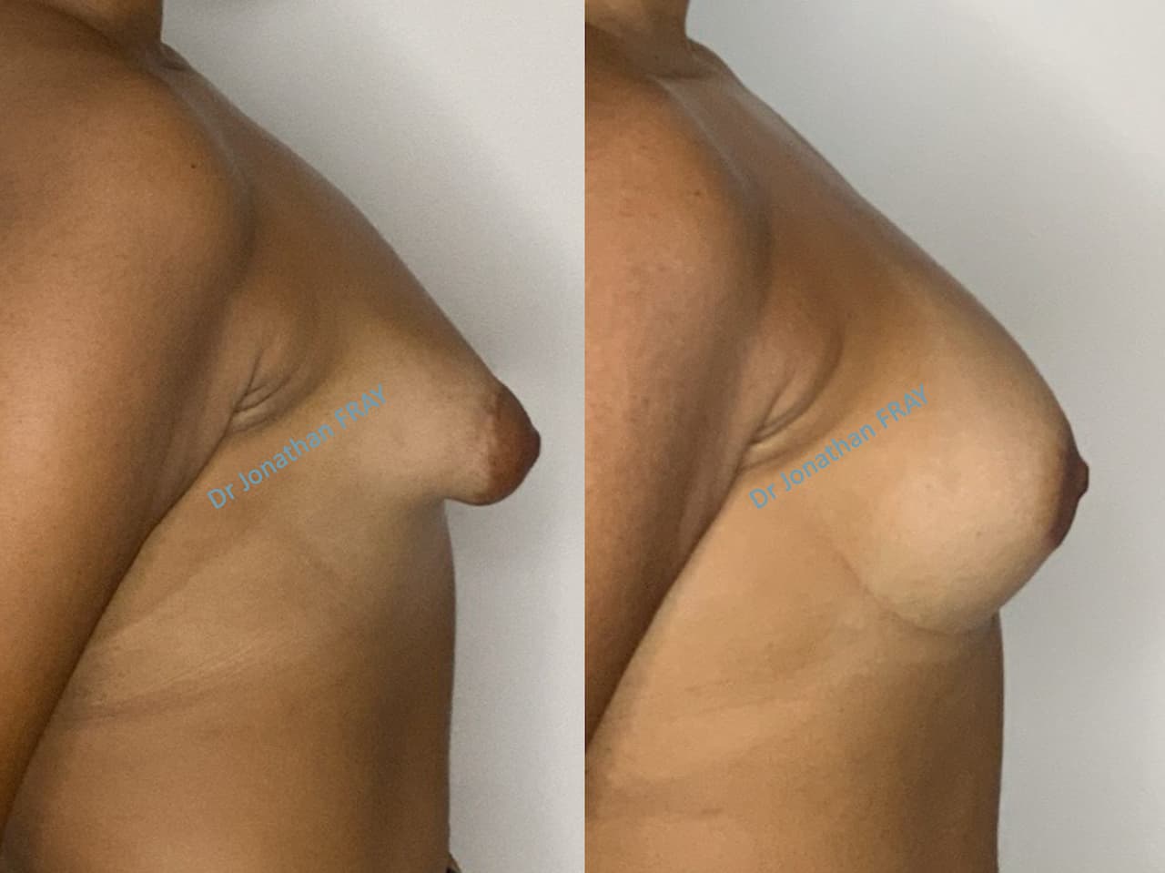 Résultats avant après de chirurgie des seins tubéreux réalisés par le Dr Fray à La Réunion - vue 1