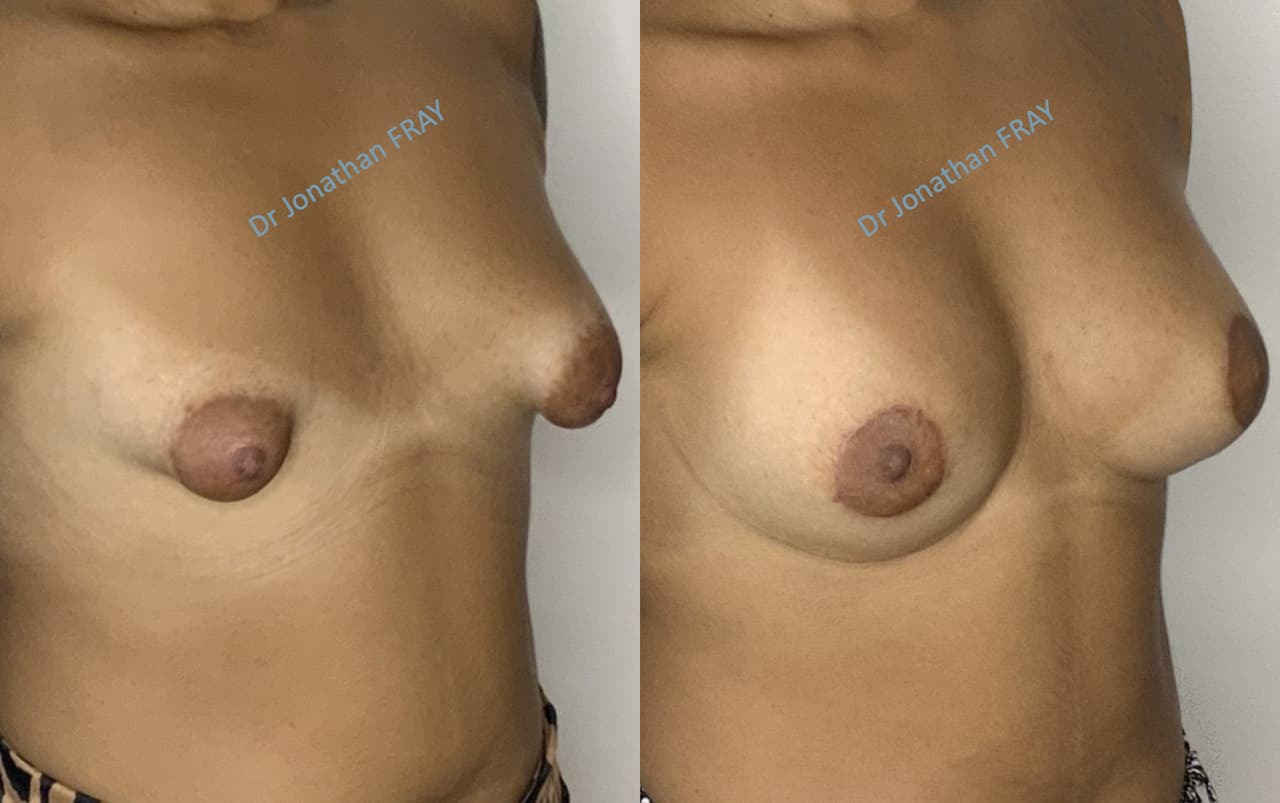 Résultats avant après de chirurgie des seins tubéreux réalisés par le Dr Fray à La Réunion - vue 2