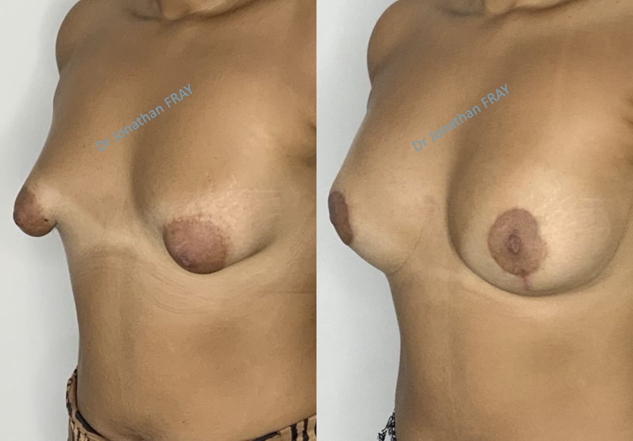 Résultats avant après de chirurgie des seins tubéreux réalisés par le Dr Fray à La Réunion - vue 4