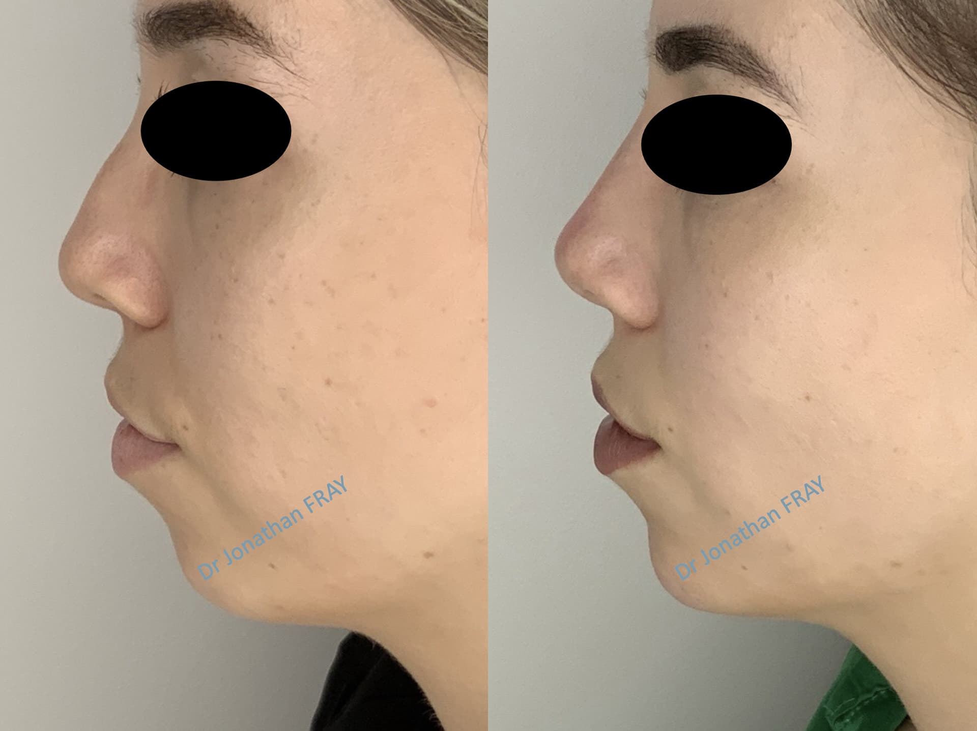 Exemple de résultats avant après d'injection d'acide hyaluronique dans le menton - vue 1