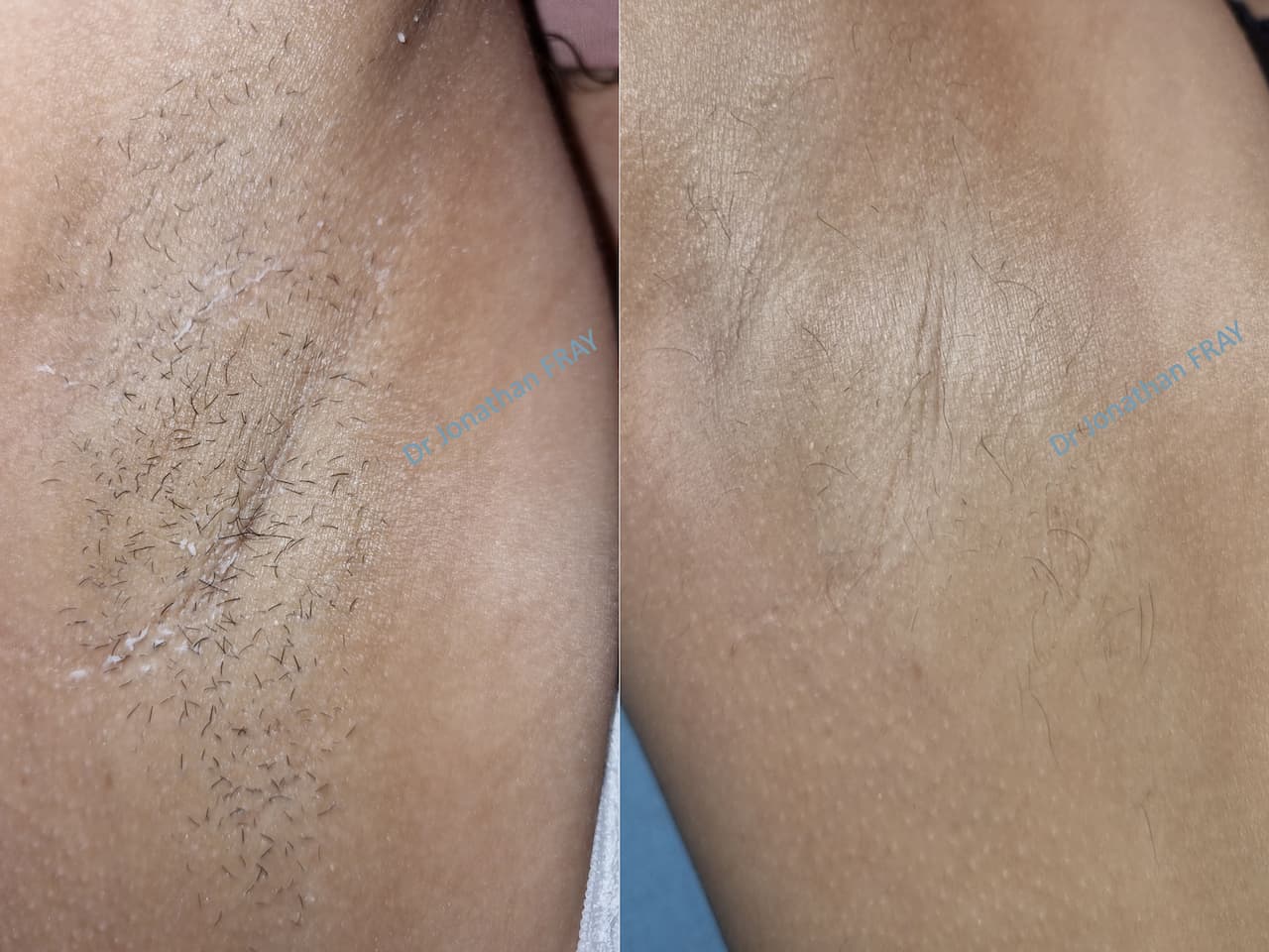 Photos avant après d'une épilation définitive des aisselles par laser à la Réunion par le Dr Fray
