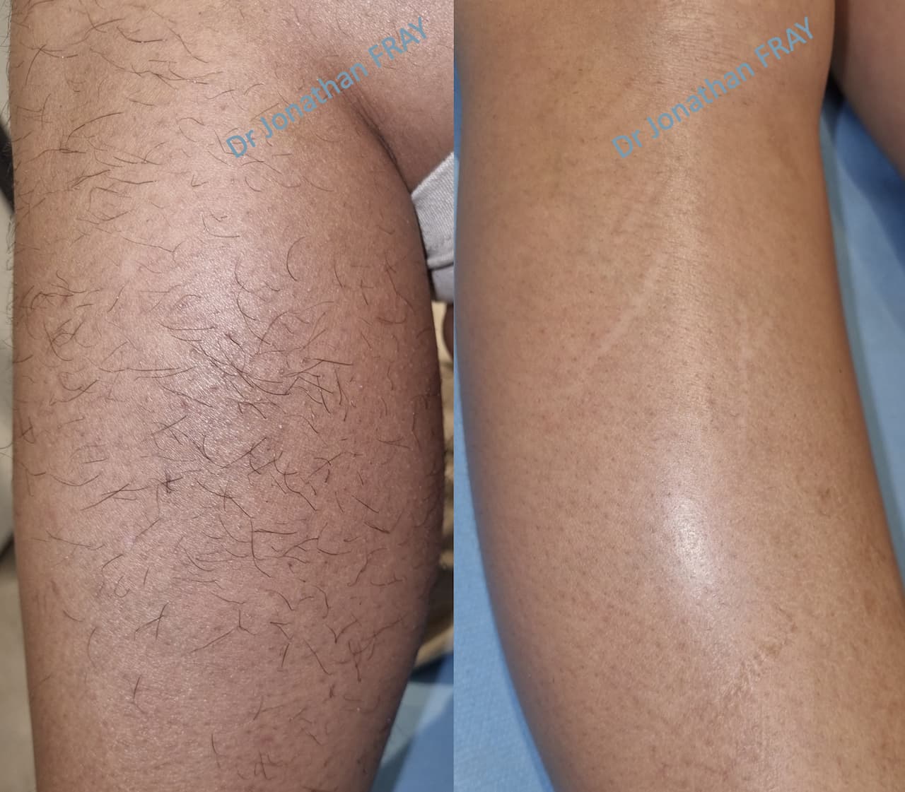 Résultats d'une épilation laser des jambes par le Dr Fray à la Réunion