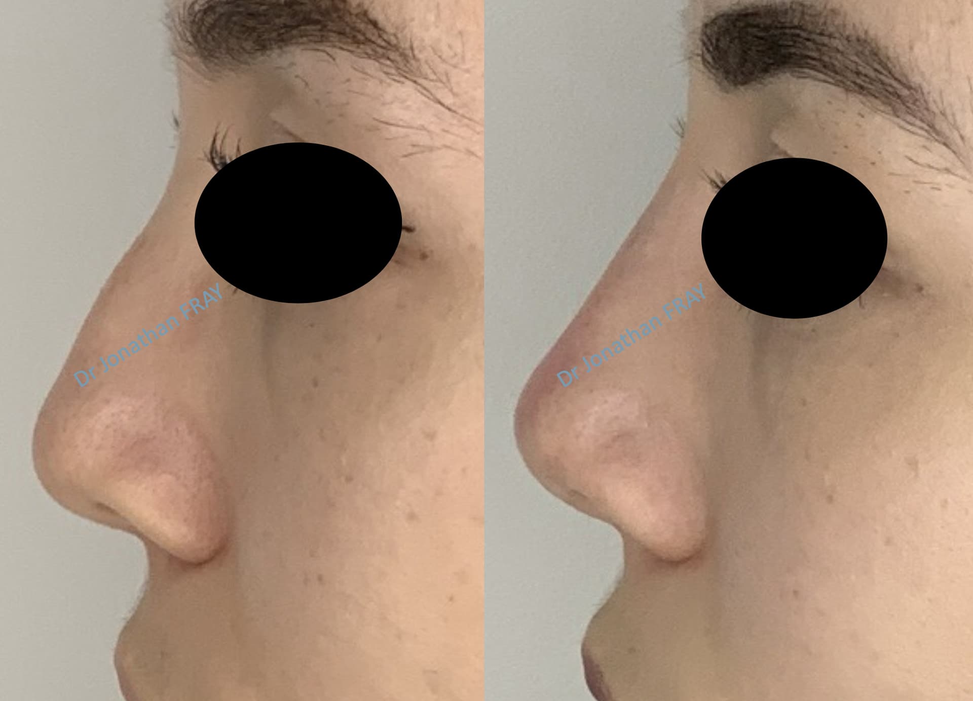 Résultat d'une rhinoplastie médicale par injection d'acide hyaluronique