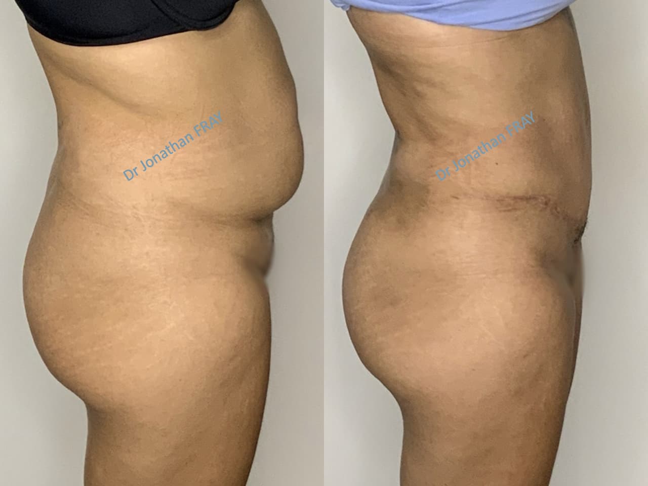 liposuccion-hanches-8-avant-apres-2-2 Résultat d'une liposuccion des hanches réalisée par le Dr Fray à La Réunion - vue 2