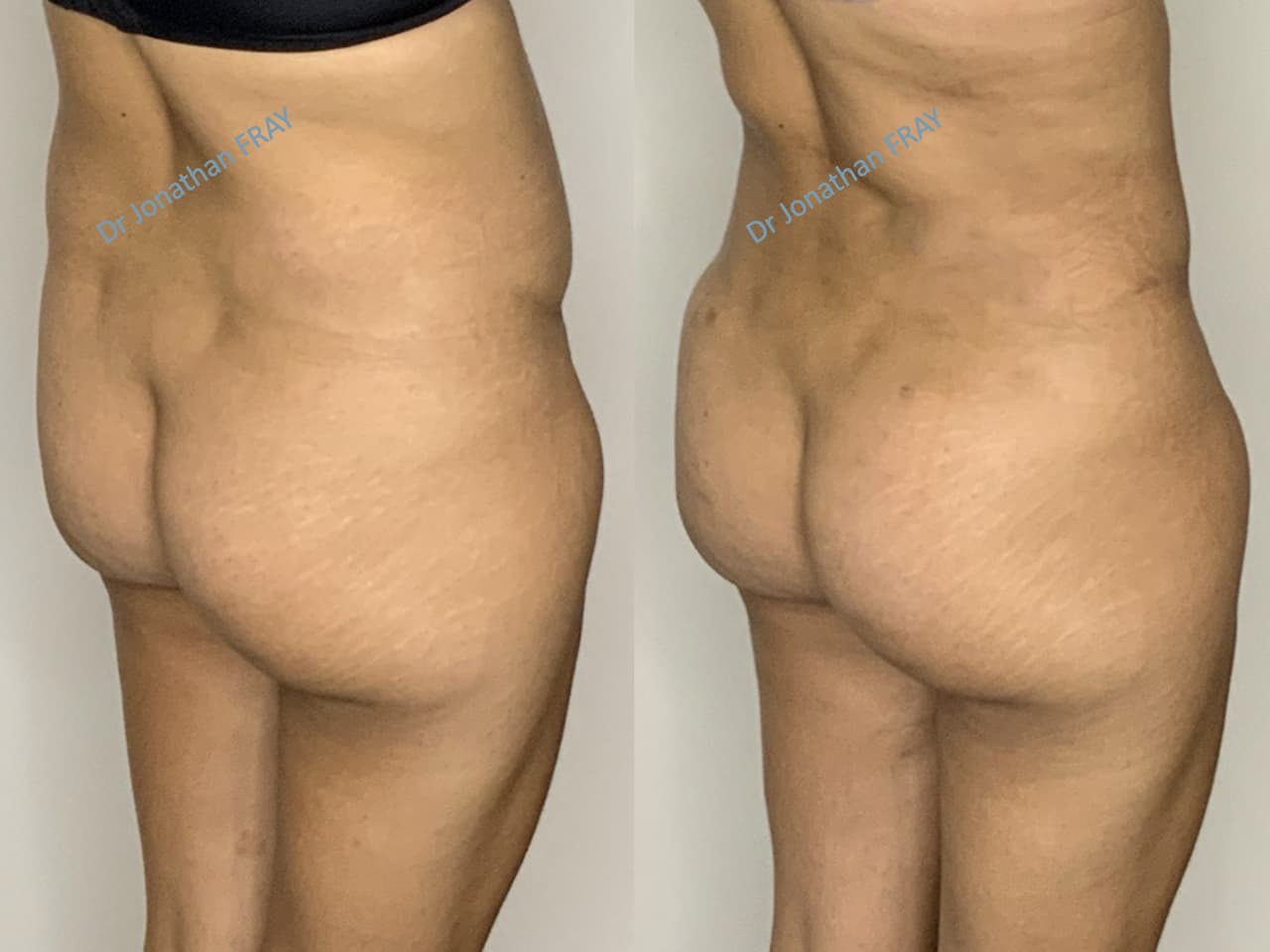 liposuccion-hanches-8-avant-apres-2-3 Résultat d'une liposuccion des hanches réalisée par le Dr Fray à La Réunion - vue 3