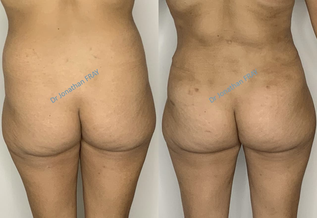 liposuccion-hanches-8-avant-apres-2-4 Résultat d'une liposuccion des hanches réalisée par le Dr Fray à La Réunion - vue 4