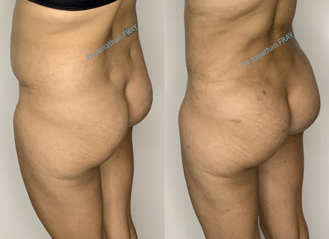 liposuccion-hanches-8-avant-apres-2-5 Résultat d'une liposuccion des hanches réalisée par le Dr Fray à La Réunion - vue 5