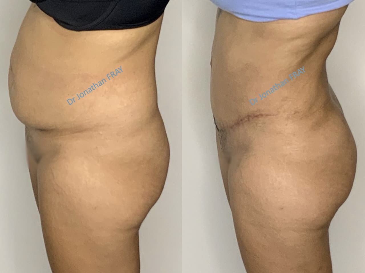 liposuccion-hanches-8-avant-apres-2-6 Résultat d'une liposuccion des hanches réalisée par le Dr Fray à La Réunion - vue 6