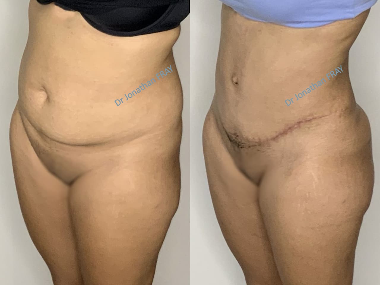 liposuccion-hanches-8-avant-apres-2-7 Résultat d'une liposuccion des hanches réalisée par le Dr Fray à La Réunion - vue 7
