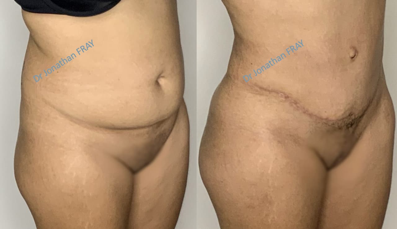 Résultat d'une abdominoplastie réalisée par le Dr Fray - vue 2