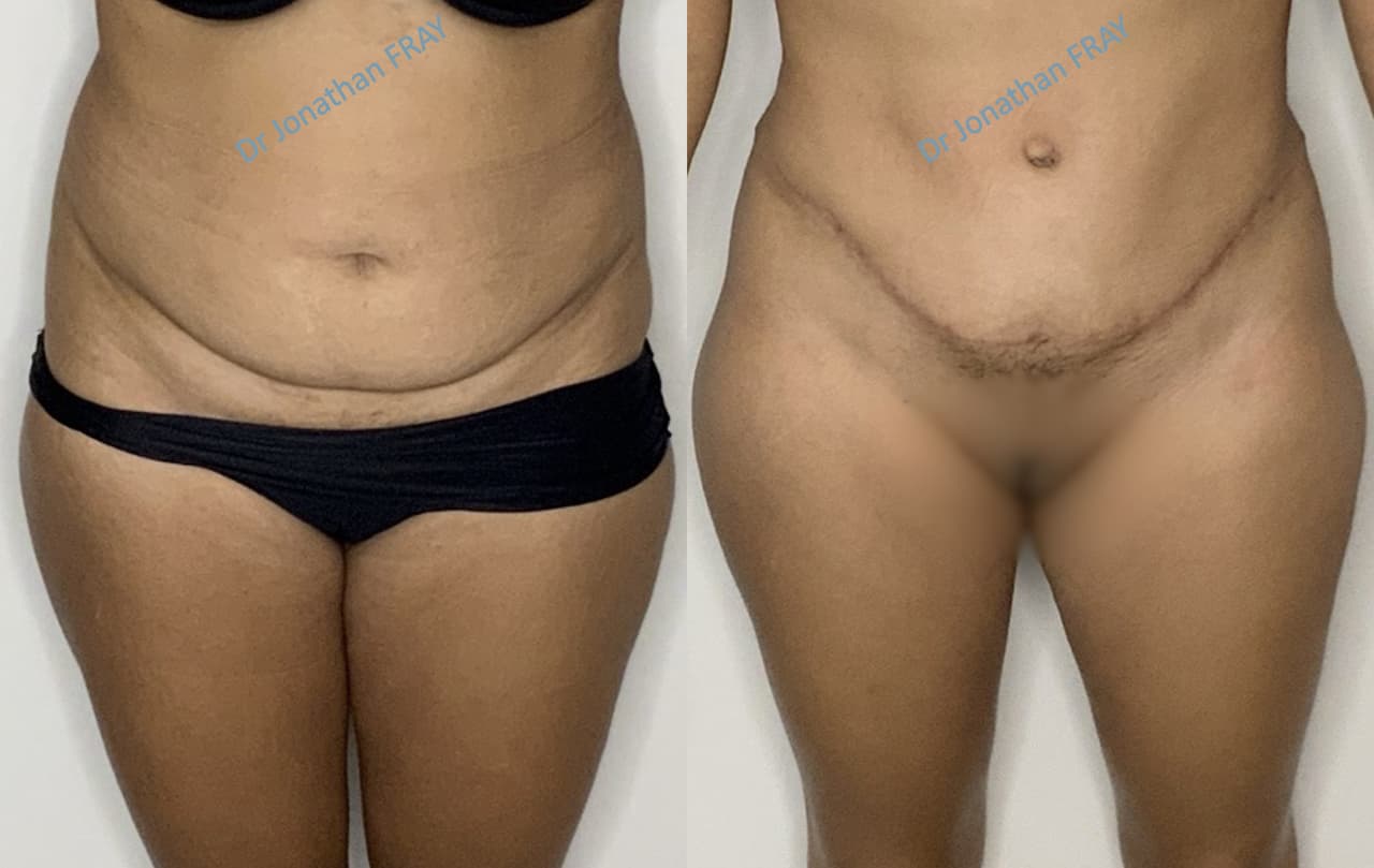 Résultat d'une abdominoplastie réalisée par le Dr Fray - vue 3