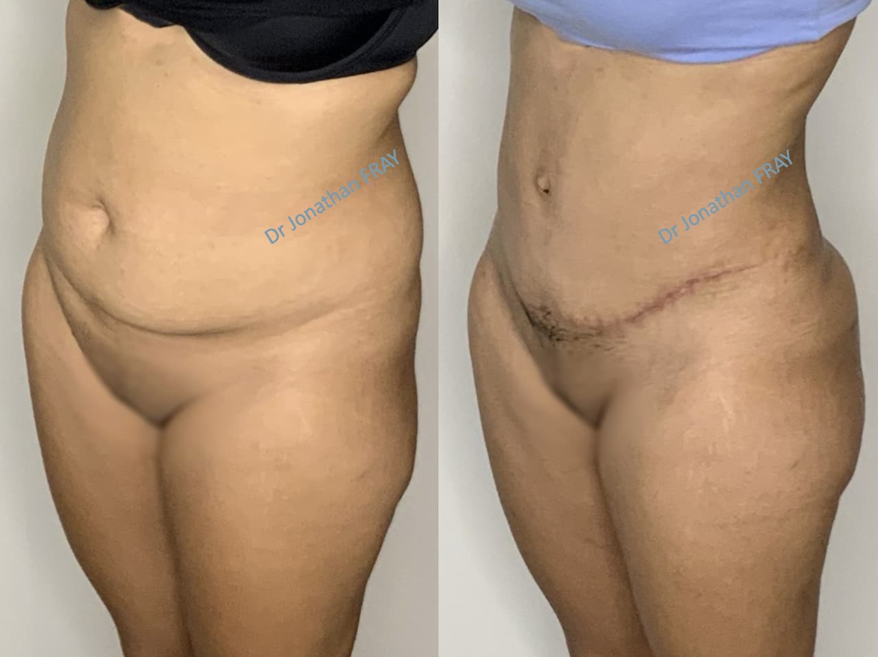 Résultat d'une abdominoplastie réalisée par le Dr Fray - vue 4